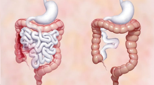 Leaky Gut Syndrome